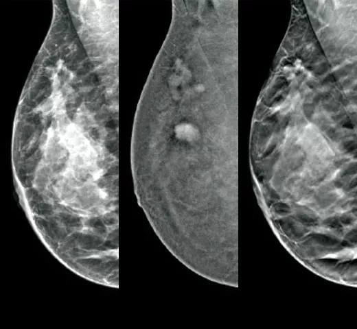 Three mammography images, a 2D image, an I-View SEM image and a 3D Slice. 